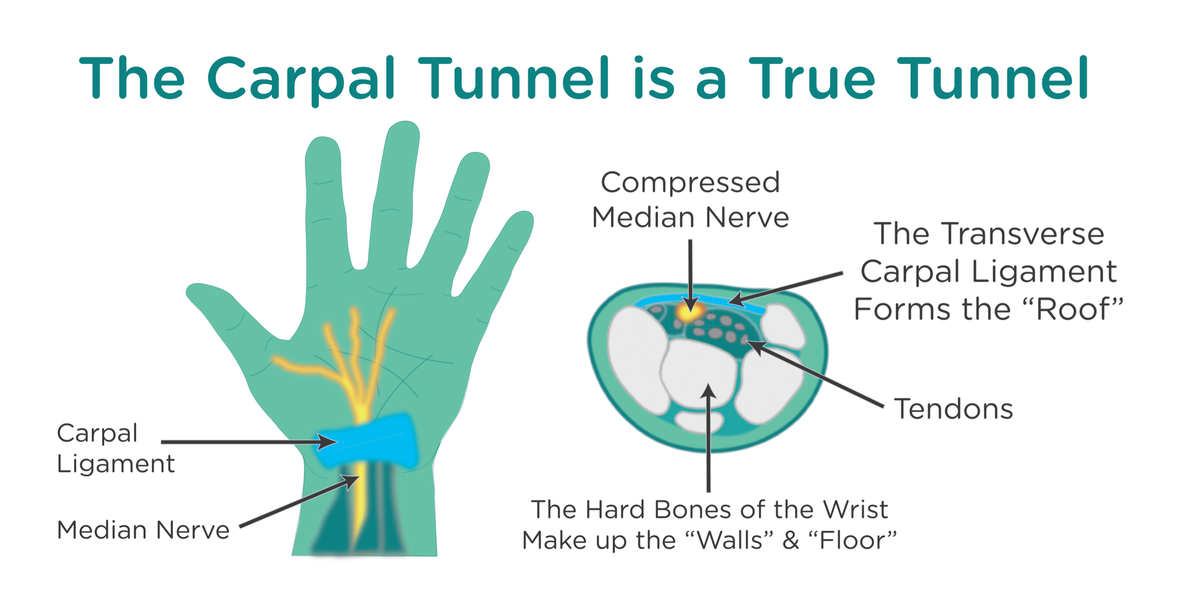 Diagram displaying the anatomy of the Carpal Tunnel.